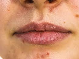 acne around mouth causes prevention