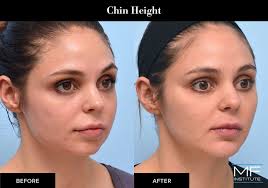 how to look older with injectables in