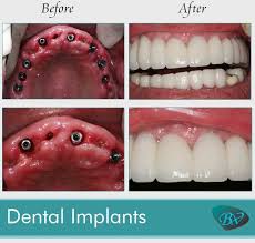 cost of dental implants in west