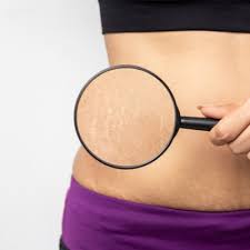 stretch marks why they appear and how