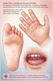 Hand, foot and mouth disease (hfmd) is a common infectious disease that occurs most often in children, but can also occur in adolescents and occasionally, in adults. What Is Hand Foot And Mouth Disease