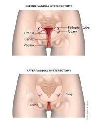 inal hysterectomy for prolapse