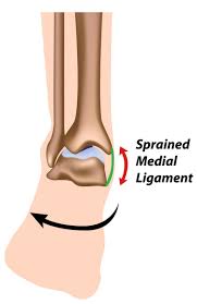 The biggest difference between a grade 2 and grade 3 ankle sprain is that in a grade 3 ankle sprain, a ligament is ruptured completely, where a grade 2 ankle sprain is only partially ruptured. Ankle Sprain Medial Upswing Health