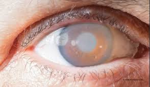 الجلوكوما أو الماء الأزرق في العين | أعراض أسباب وطرق العلاج - مجمع بطل  التخصصي