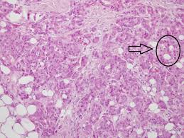 Histopathology Case Study          u   chem m a   Histopathology Objectives  In thischapter we will study   some of the factors leading to cellular National Cancer Institute