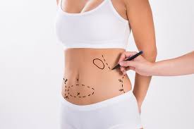 a liposuction recovery timeline