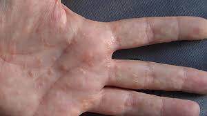 The pest penetrates the top layer of your skin to lay itchiness in specific areas of the body including the elbow, armpit, wrist as well as the web between fingers. Dyshidrotic Eczema Overview Causes Diagnosis And Pictures