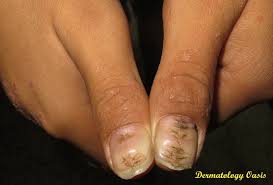 nail disorders dermatology oasis