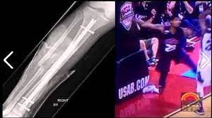 Paul george suffered a serious leg injury during team usa's scrimmage on friday night. Injury Of The Week Compound Fracture Of The Tibia And Fibula Symmetry Physiotherapy