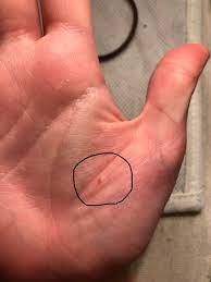 There are many types of skin cancer, each of which can look different on the skin. Melanoma Alm Mole On My Palm Is Now Raised Melanoma