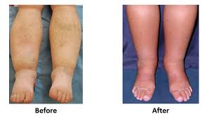 feet swelling treatment causes