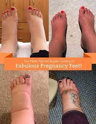 swollen feet during pregnancy natural