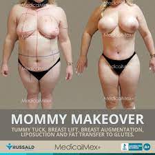 Mommy Makeover Surgery in Tijuana, Mexico - Dr. Lupita Carrillo