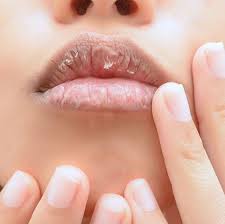 home remes to treat chapped lips