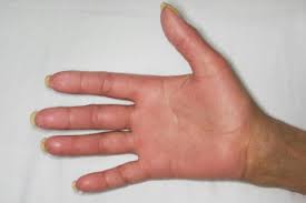 This condition might involve the other surfaces of the palm, such as the thenar eminence or the fingers. Clinical And Histopathological Spectrum Of Toxic Erythema Of Chemotherapy In Patients Who Have Undergone Allogeneic Hematopoietic Cell Transplantation Sciencedirect