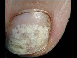 white toenails after polish or pedicure