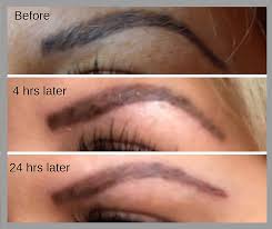 removal of tattoo eyebrows or lip