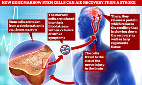 Stem Cell Injections Boost 25 Stroke Patients Recovery By