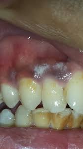 dentist for white spots on gums