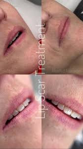 lip scar removal treatment