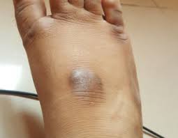 black mark on my feet