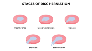 treating an l5 s1 disc herniation a