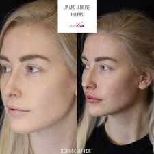 An aesthetic doctor explains why we're all asking for juvéderm volux in a quest for more defined jawlines. Meet Our Lovely Client Nicola Skinviva Manchester