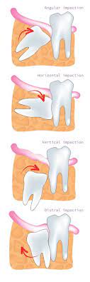 Wisdom teeth are the last set of molars that typically appear between the ages 17 and 25. Wisdom Teeth Removal In Malvern Ascent Dental Care Malvern