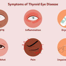 thyroid eye disease symptoms causes