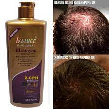 The top countries of suppliers are russian federation, china, and india, from which the percentage of dandruff and hair loss shampoo supply is 1%, 83%, and 4% respectively. Anti Off Hair Growth Natural Herbal Chinese Anti Dandruff Shampoo 420g Free Shipping Anti Dandruff Shampoo Dandruff Shampooanti Dandruff Aliexpress