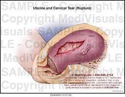 uterine and cervical tear rupture