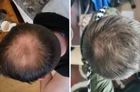people who tried out hair loss