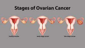Ovarian cancer and irritable bowel syndrome or ibs (a functional disorder of the digestive tract) share symptoms like abdominal pain and cramping, diarrhea, constipation, gas, and bloating. What Are The Stages Of Ovarian Cancer Everyday Health