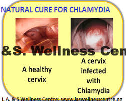 chlamydia infection