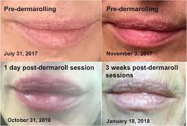 dermarolling to rejuvenate lips by