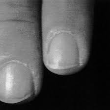 nails in systemic disease springerlink