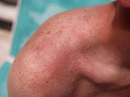 hot tub folliculitis rash treatment