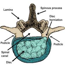 lumbar disc herniation frequently