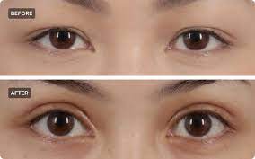 double eyelid surgery what you need to