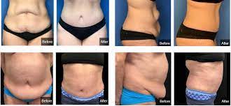 tummy tuck surgery after weight loss or