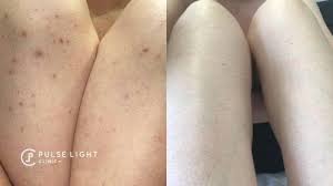 This study details the cost of professional laser hair removal done by physicians and estheticians throughout the unites states. Laser Hair Removal London Pulse Light Clinic London
