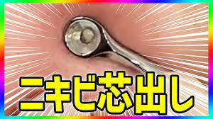 ニキビ芯出し・ニキビ潰す動画 acne treatment in Japan - YouTube