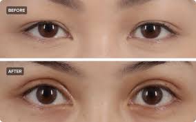 double eyelid surgery what you need to
