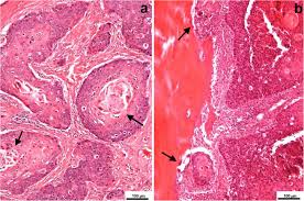 aggressive squamous cell carcinoma of