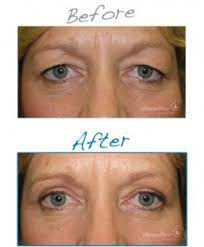 excess eyelid skin is a quick fix with