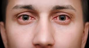 burning eyes causes symptoms