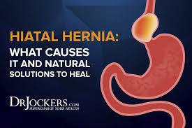 Hiatal Hernia What It Is And Natural Treatments Drjockers Com