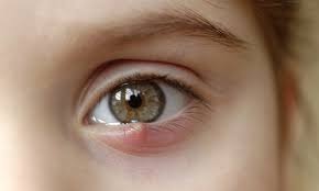 what is a stye and how do you treat