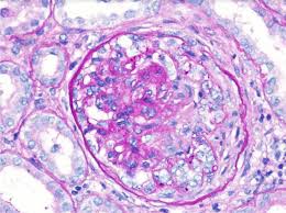 Anti Glomerular Basement Membrane