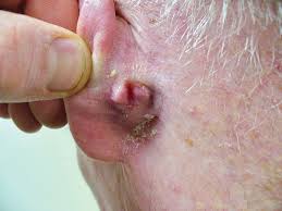 pink nodule behind the ear mdedge